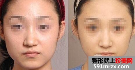 咬肌切除手术价格|手术去咬肌会留疤吗