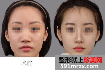 武汉鼻整形价格表详细版本曝光