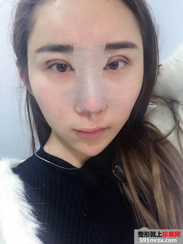 双眼皮修复鼻综合整形真实恢复日记，逆袭变女神