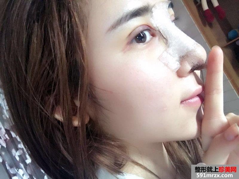 双眼皮修复鼻综合整形真实恢复日记，逆袭变女神
