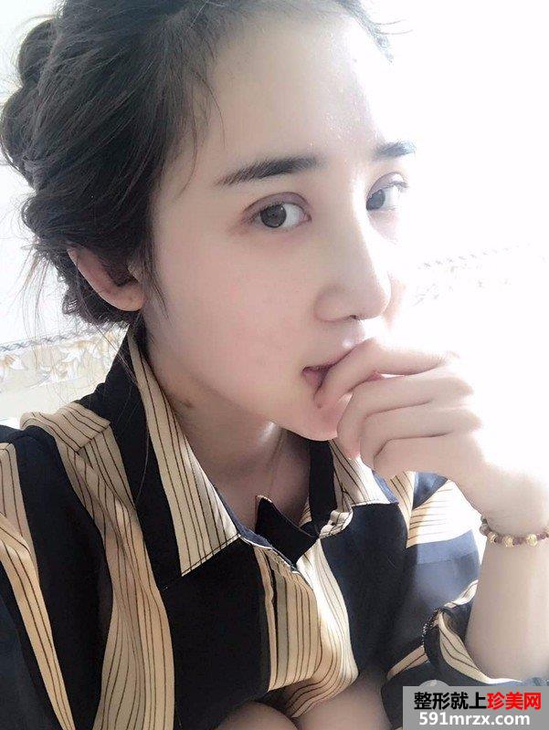 双眼皮修复鼻综合整形真实恢复日记，逆袭变女神