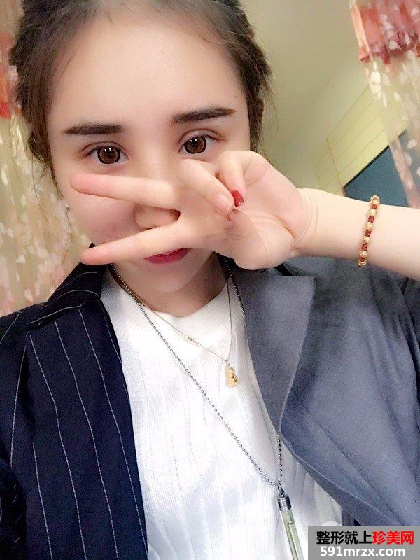 双眼皮修复鼻综合整形真实恢复日记，逆袭变女神