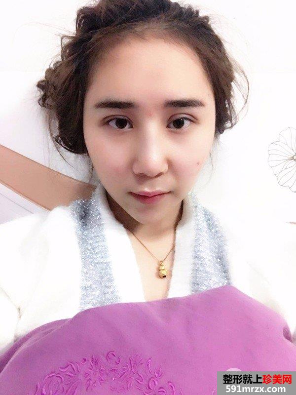双眼皮修复鼻综合整形真实恢复日记，逆袭变女神