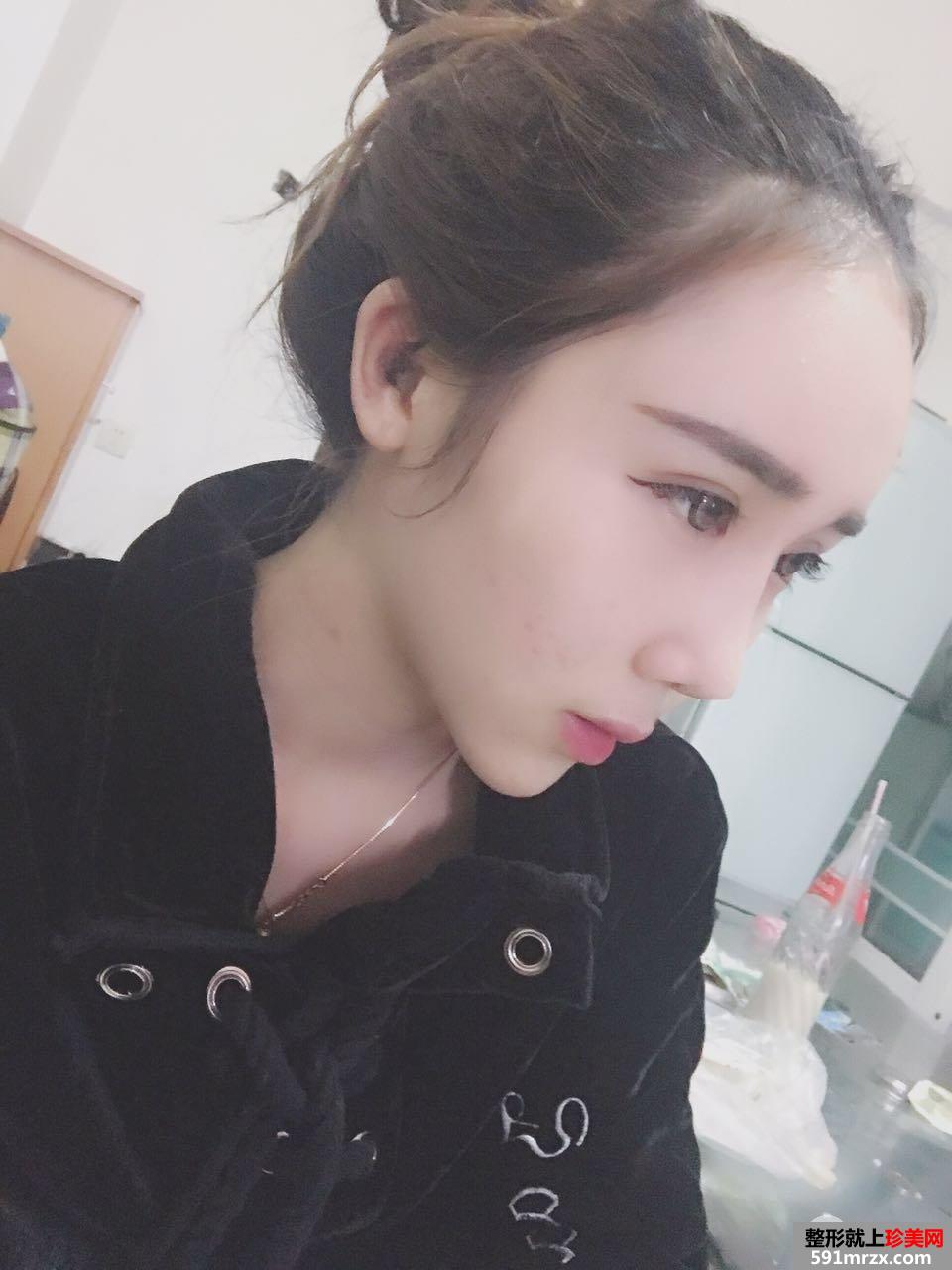 双眼皮修复鼻综合整形真实恢复日记，逆袭变女神