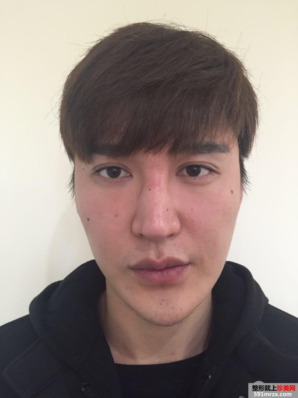 男生做假体隆鼻修复手术真实案例图