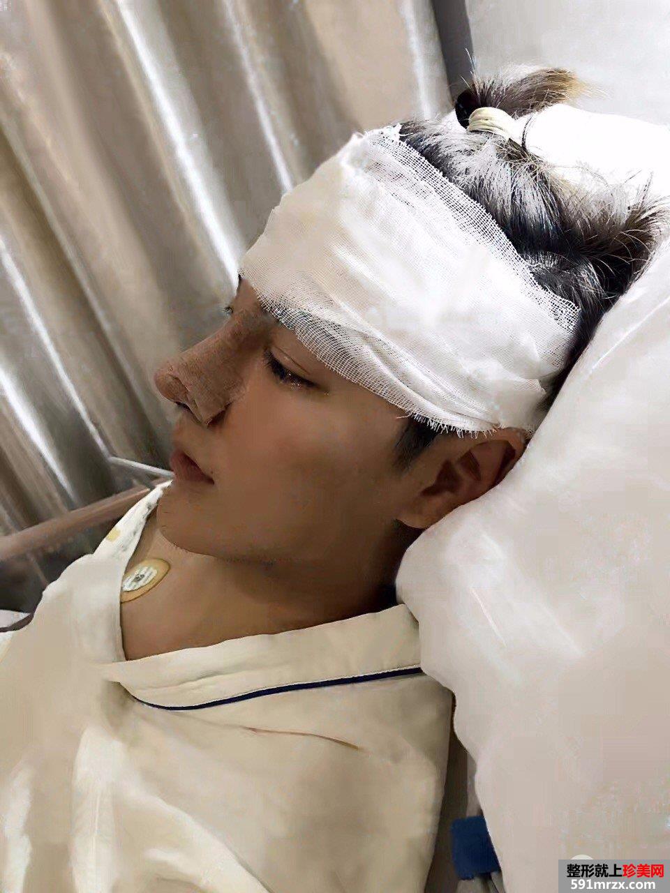男生做假体隆鼻修复手术真实案例图