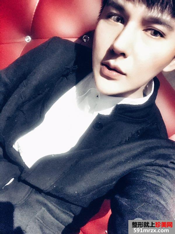 男生做假体隆鼻修复手术真实案例图