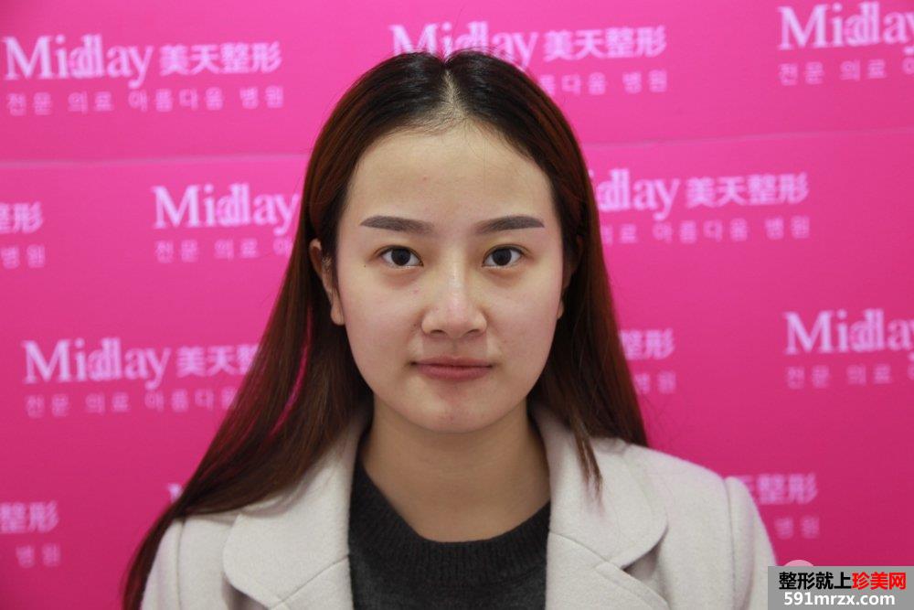 假体隆鼻修复+肋软骨垫鼻尖真实案例分享
