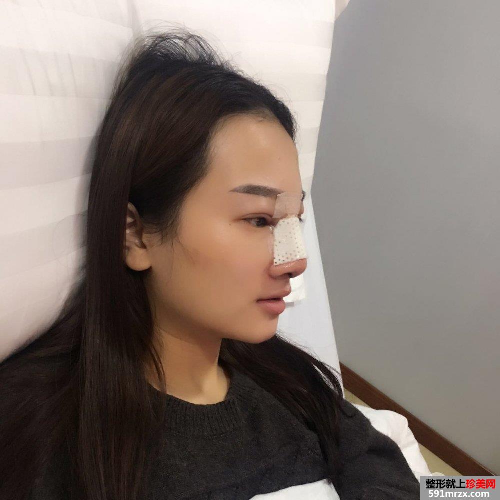 假体隆鼻修复+肋软骨垫鼻尖真实案例分享