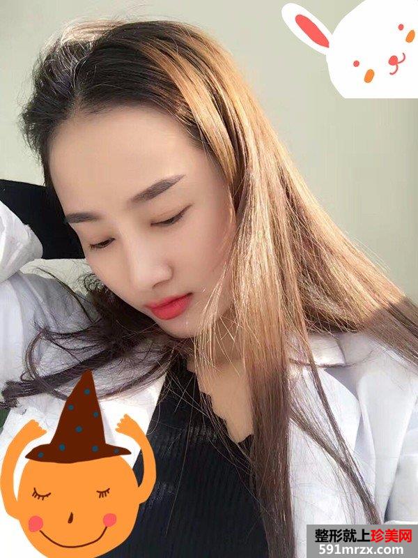 假体隆鼻修复+肋软骨垫鼻尖真实案例分享
