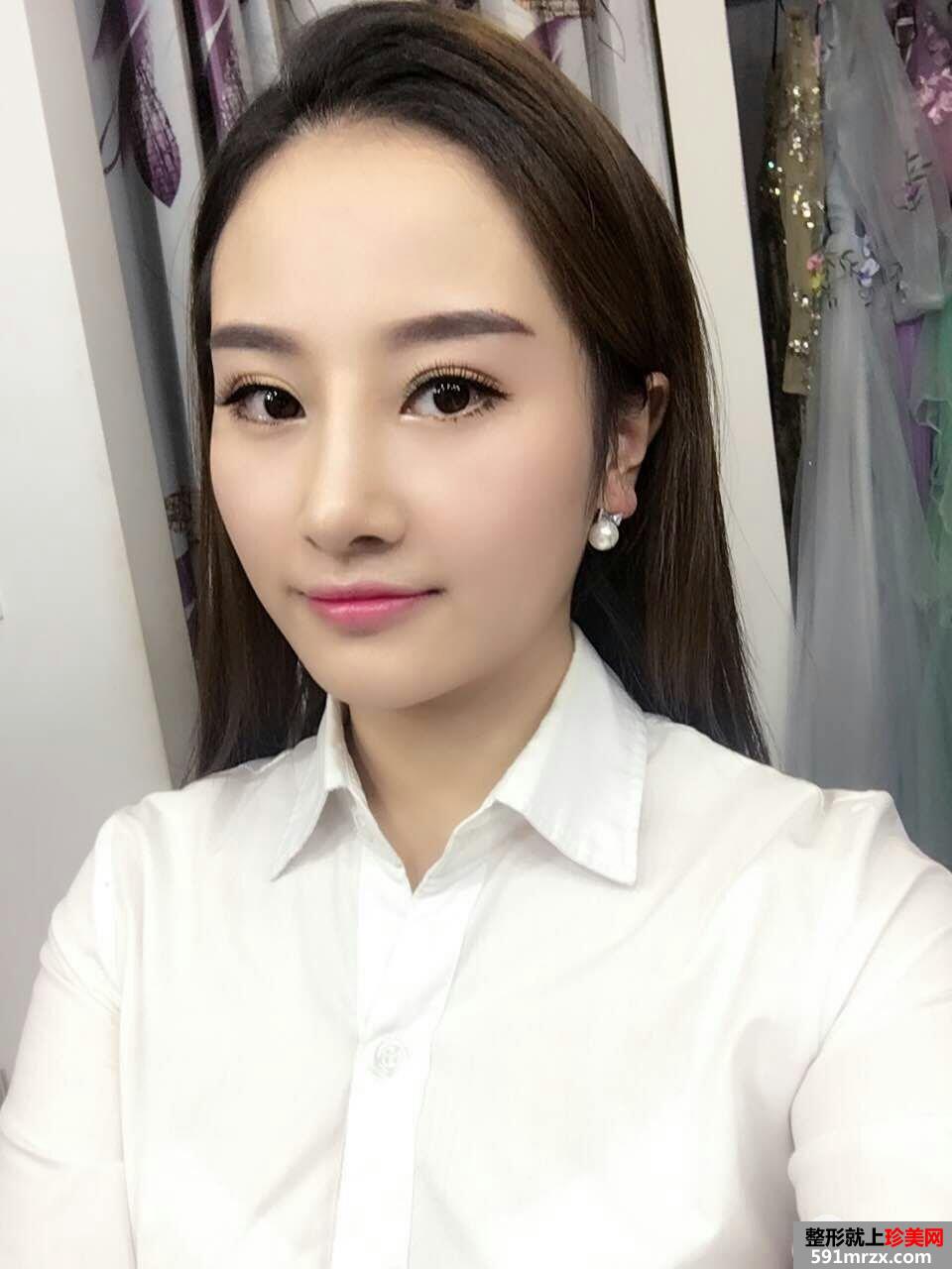 假体隆鼻修复+肋软骨垫鼻尖真实案例分享