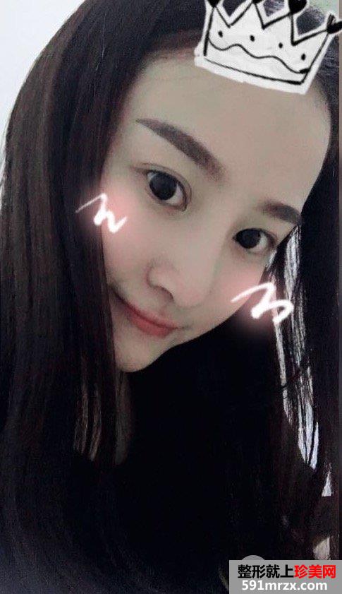 假体隆鼻修复+肋软骨垫鼻尖真实案例分享