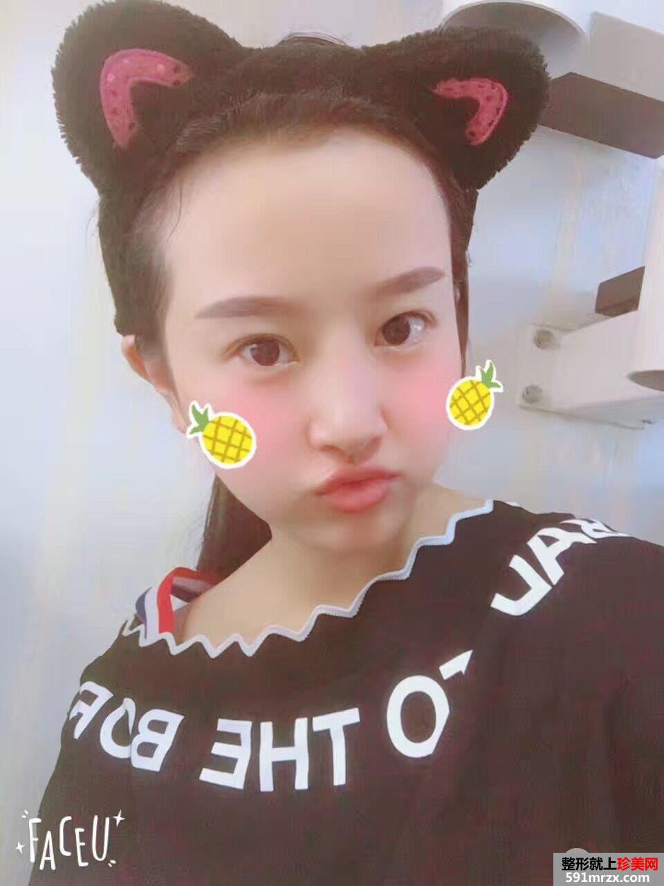 假体隆鼻修复+肋软骨垫鼻尖真实案例分享