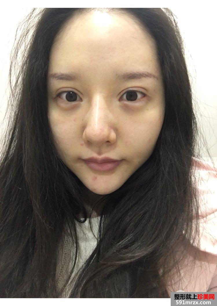 自体脂肪丰鼻唇沟真实记录前后效果对比图