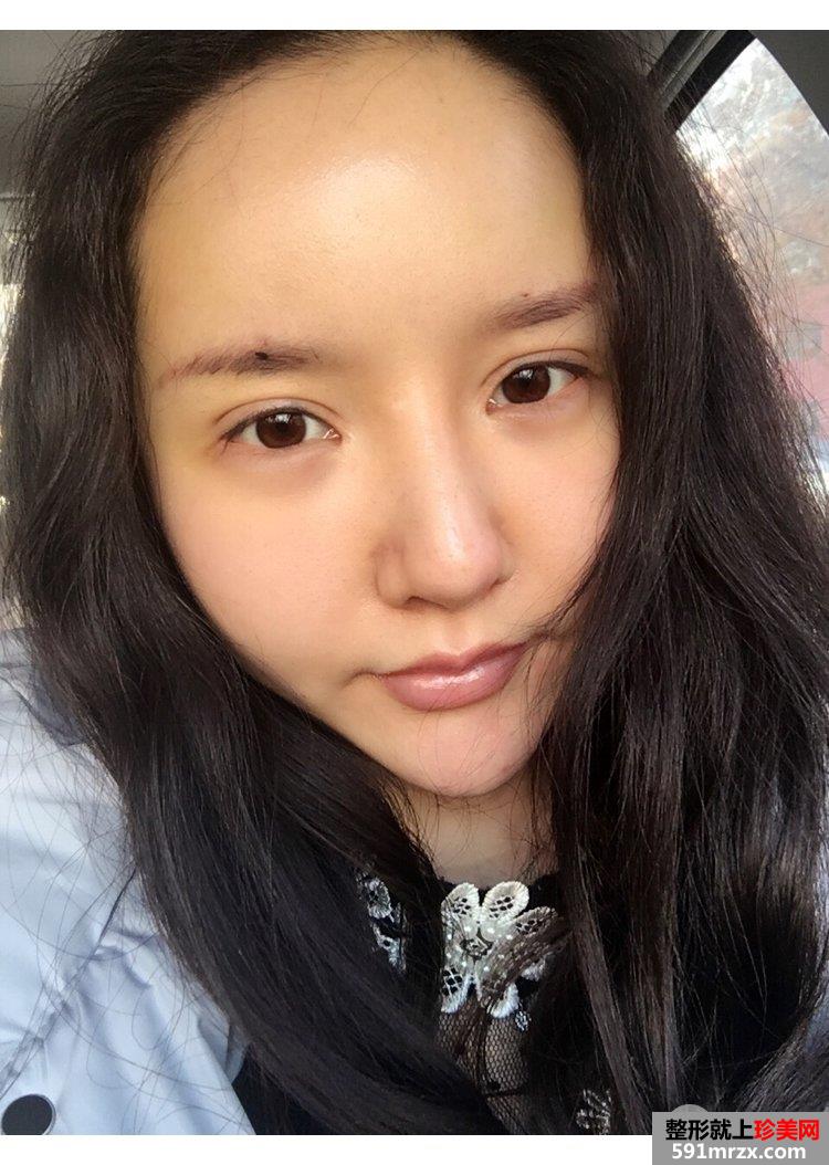 自体脂肪丰鼻唇沟真实记录前后效果对比图