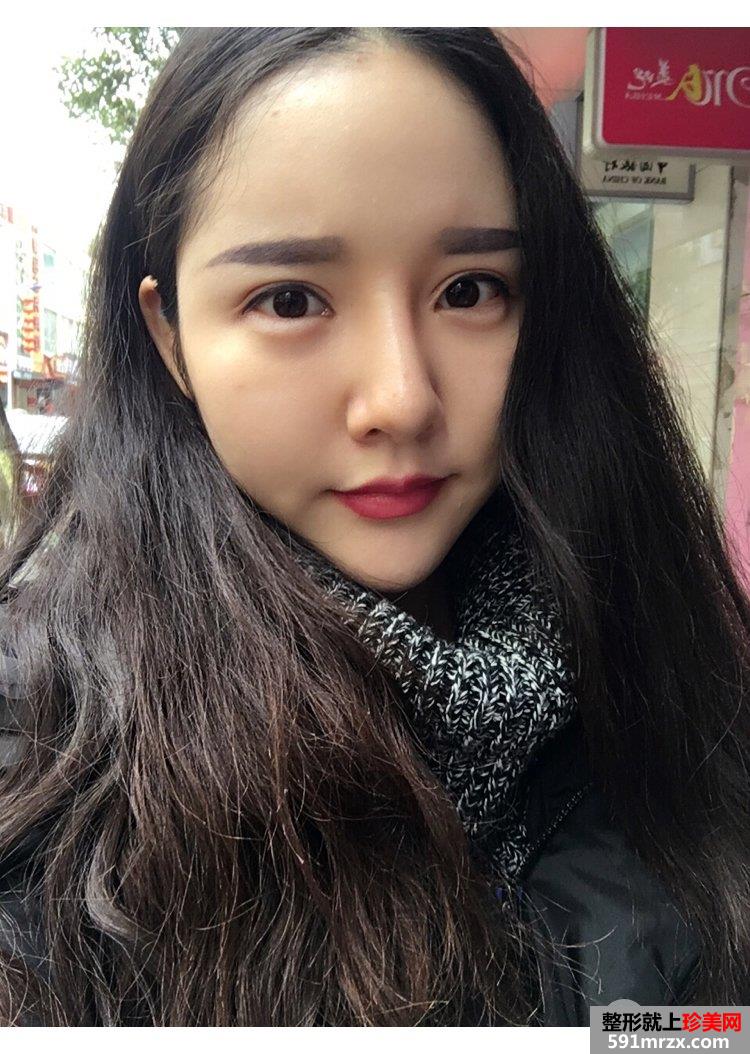 自体脂肪丰鼻唇沟真实记录前后效果对比图