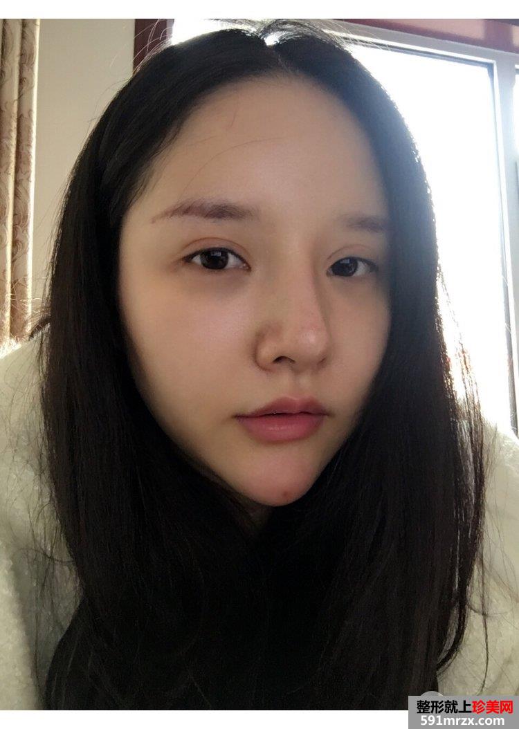 自体脂肪丰鼻唇沟真实记录前后效果对比图