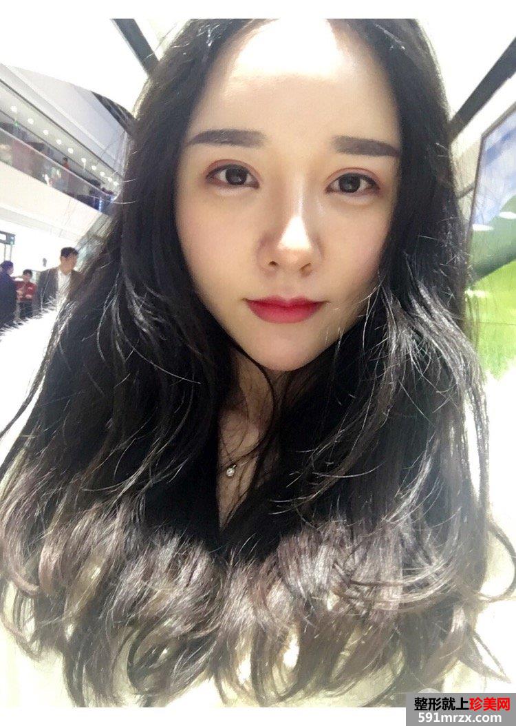 自体脂肪丰鼻唇沟真实记录前后效果对比图