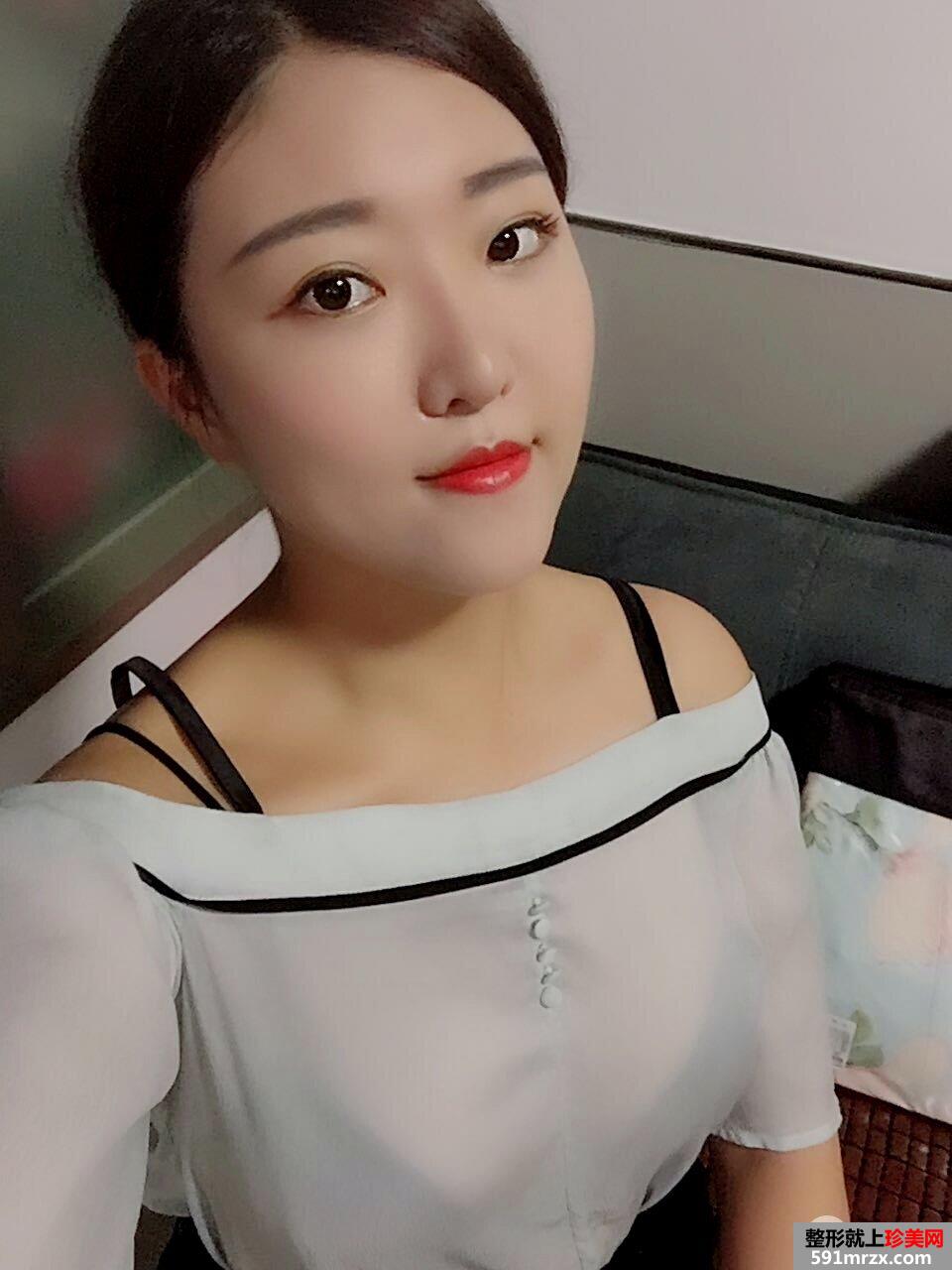 曼托圆形假体隆胸术后三个月恢复效果图，真实案例分享