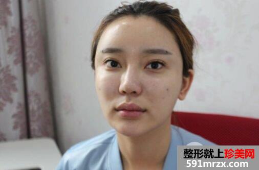 自体脂肪全脸填充过程记录分享 减龄立变美少女