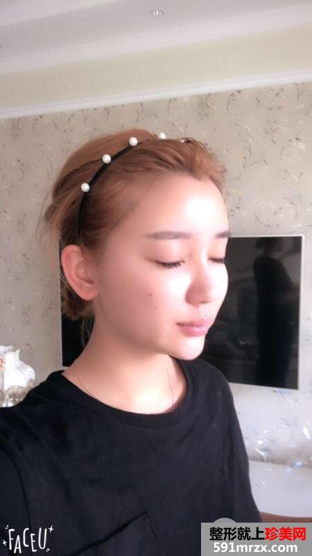 自体脂肪全脸填充过程记录分享 减龄立变美少女
