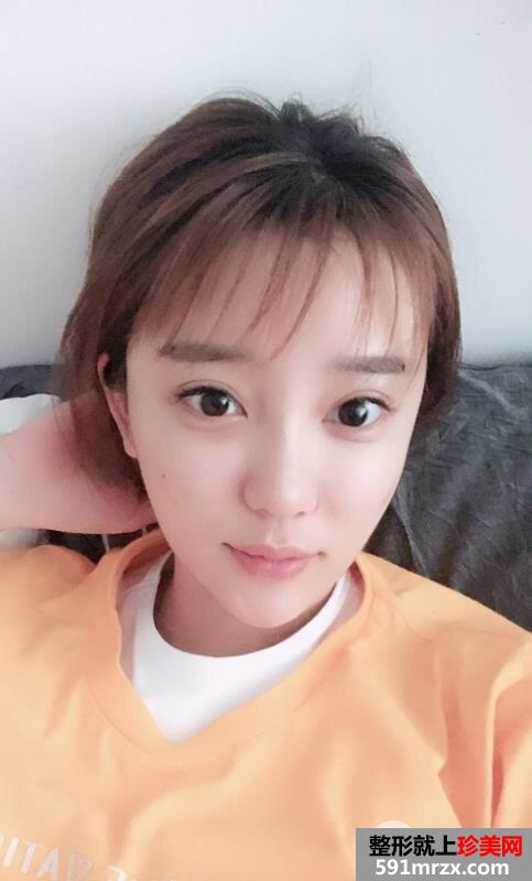 自体脂肪全脸填充过程记录分享 减龄立变美少女