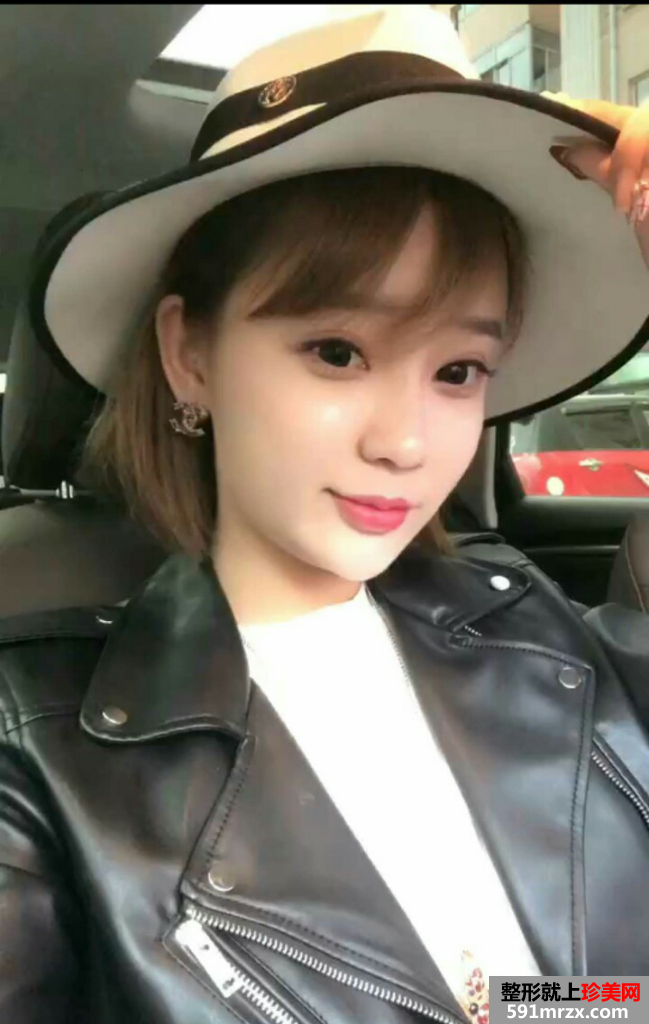 自体脂肪全脸填充过程记录分享 减龄立变美少女