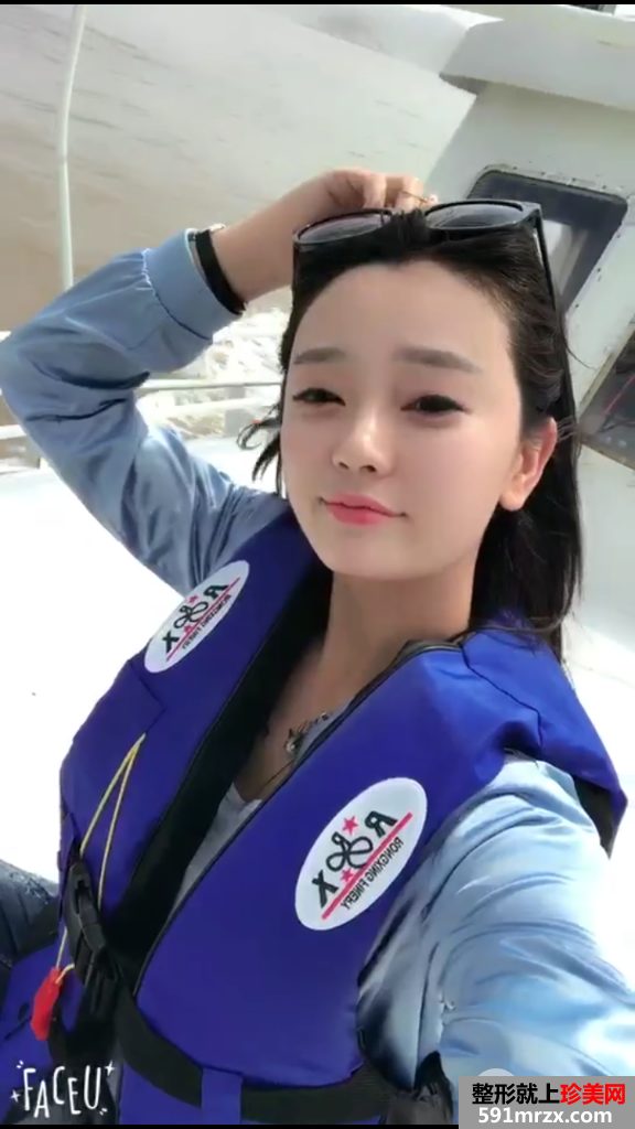 自体脂肪全脸填充过程记录分享 减龄立变美少女