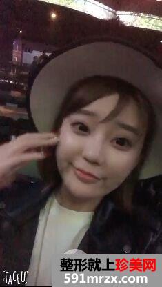 自体脂肪全脸填充过程记录分享 减龄立变美少女