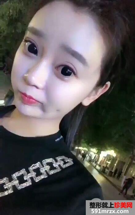 自体脂肪全脸填充过程记录分享 减龄立变美少女