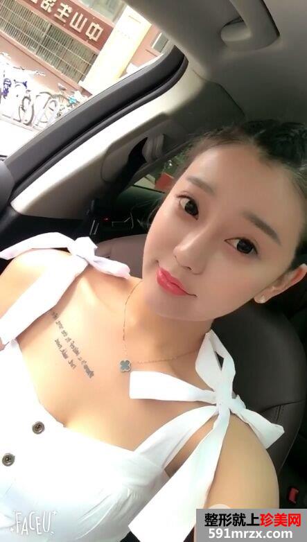 自体脂肪全脸填充过程记录分享 减龄立变美少女