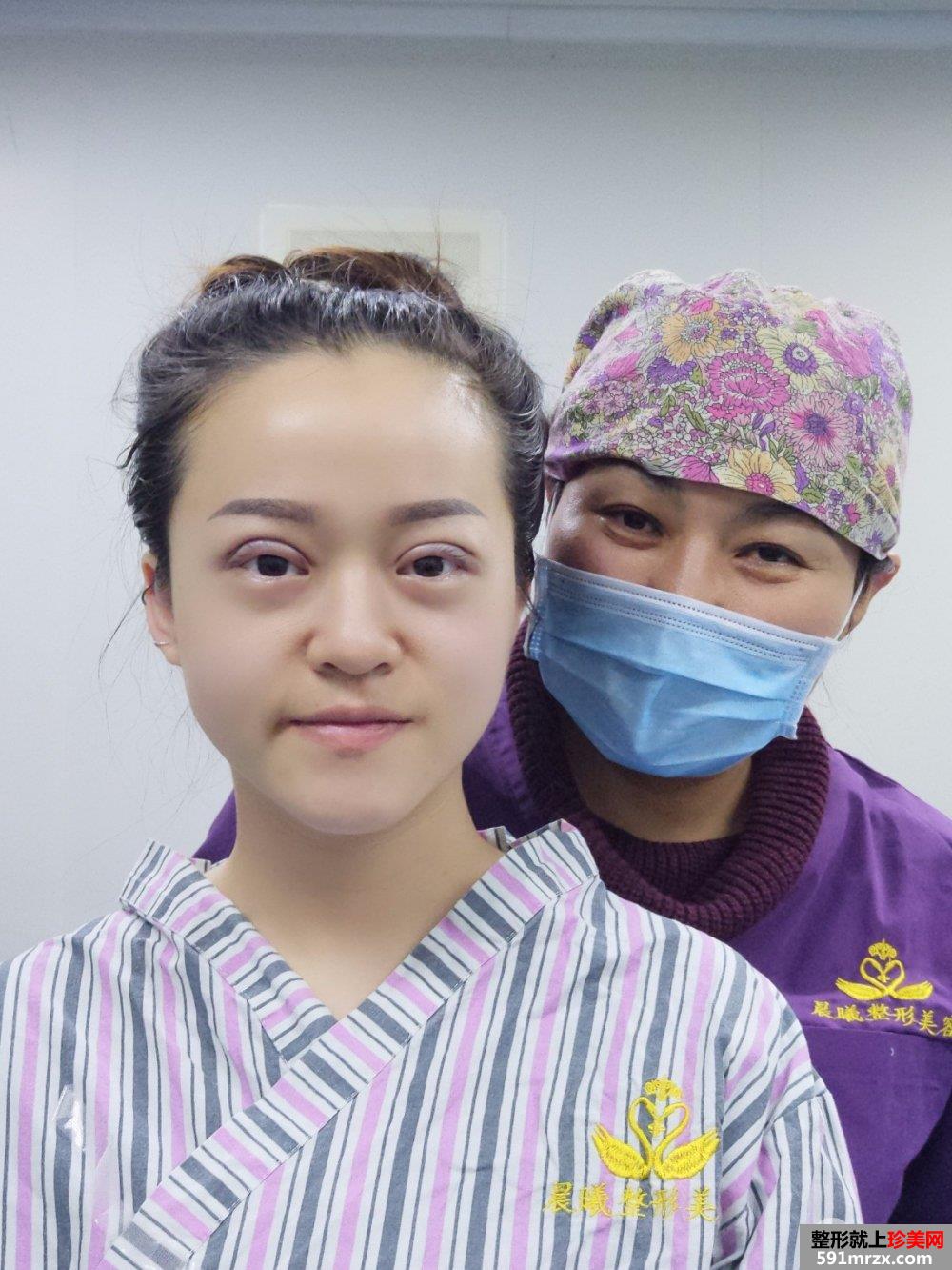 深圳全切双眼皮真实案例对比图分享，神似迪丽热巴