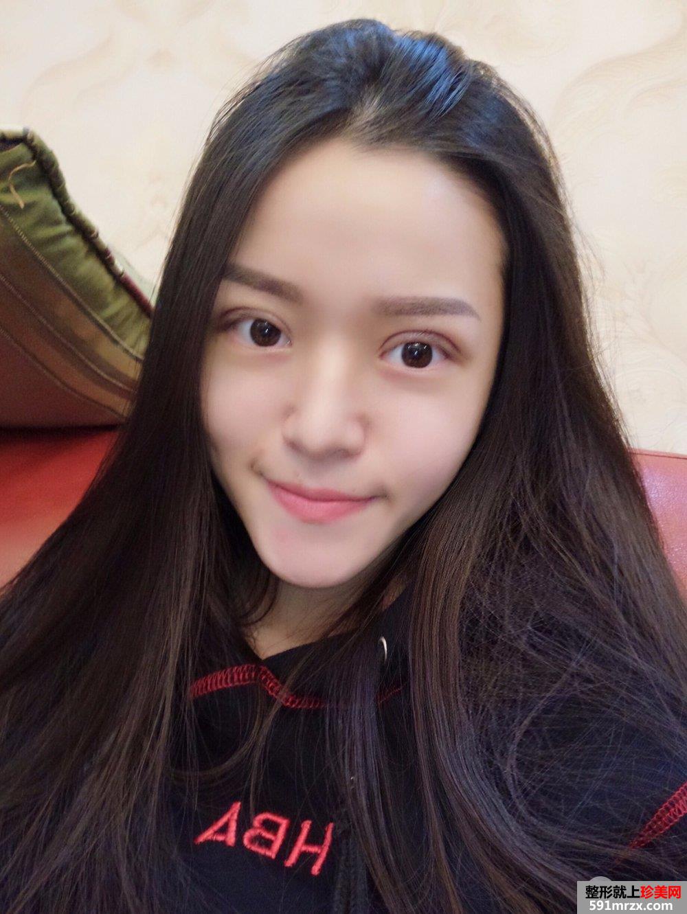 深圳全切双眼皮真实案例对比图分享，神似迪丽热巴