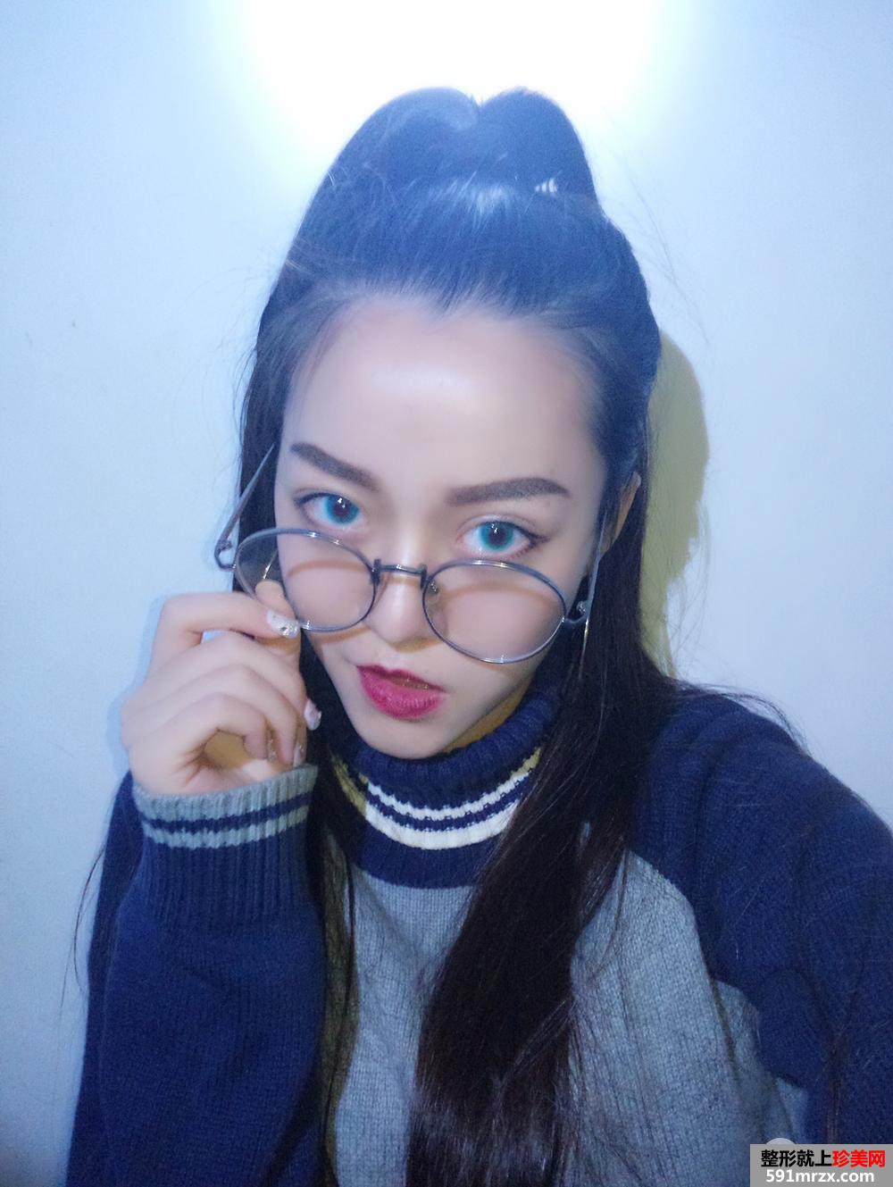 深圳全切双眼皮真实案例对比图分享，神似迪丽热巴