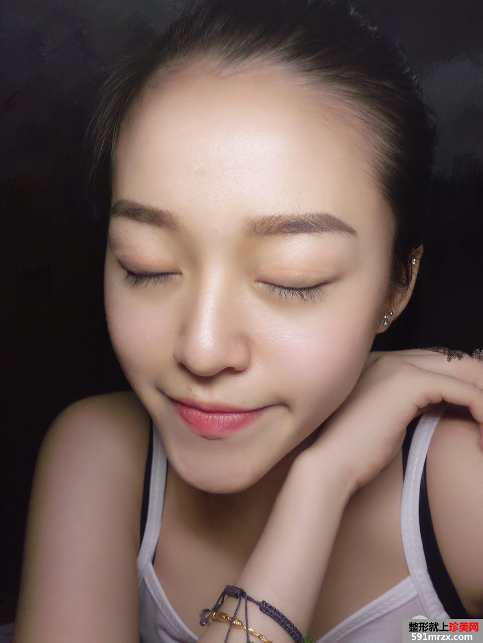 深圳全切双眼皮真实案例对比图分享，神似迪丽热巴