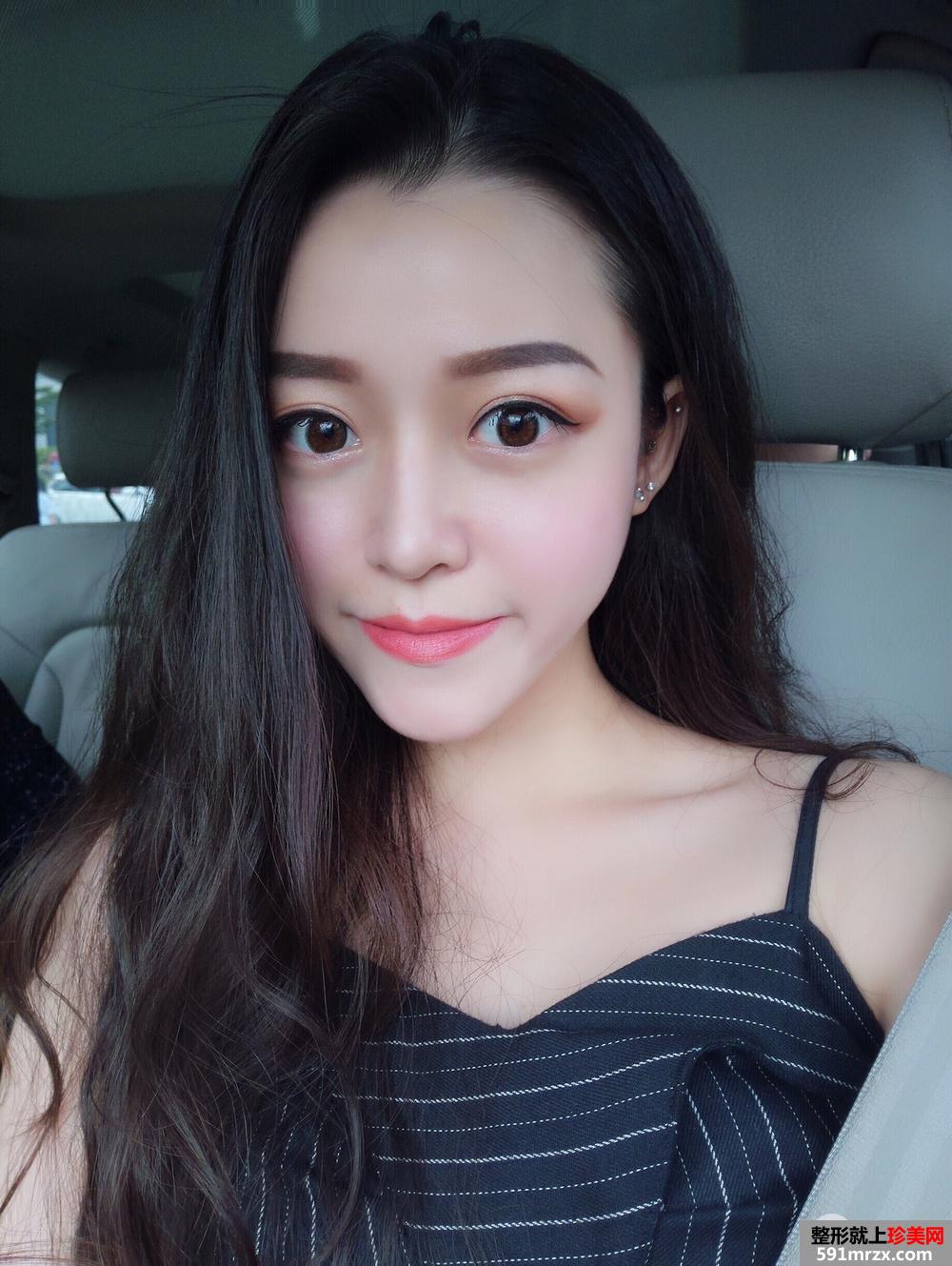 深圳全切双眼皮真实案例对比图分享，神似迪丽热巴
