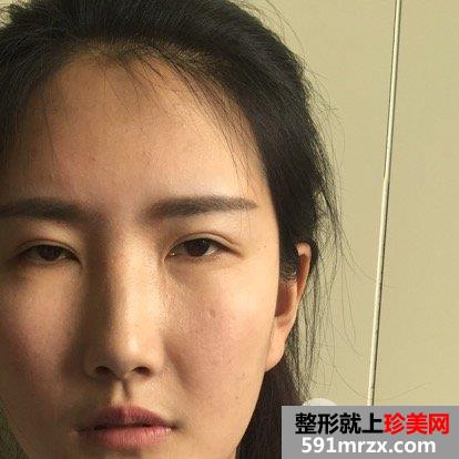 自体脂肪面部填充+双眼皮失败修复真实恢复记录