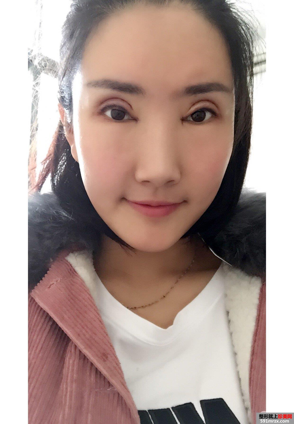 自体脂肪面部填充+双眼皮失败修复真实恢复记录