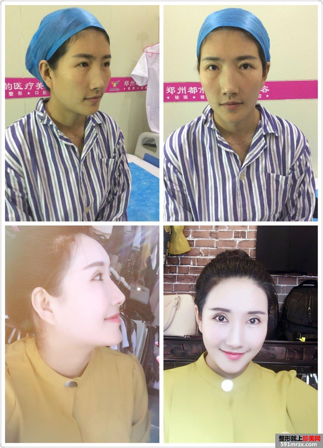 自体脂肪面部填充+双眼皮失败修复真实恢复记录