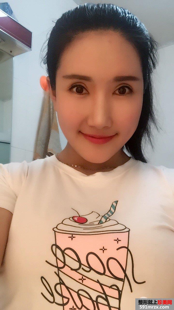 自体脂肪面部填充+双眼皮失败修复真实恢复记录
