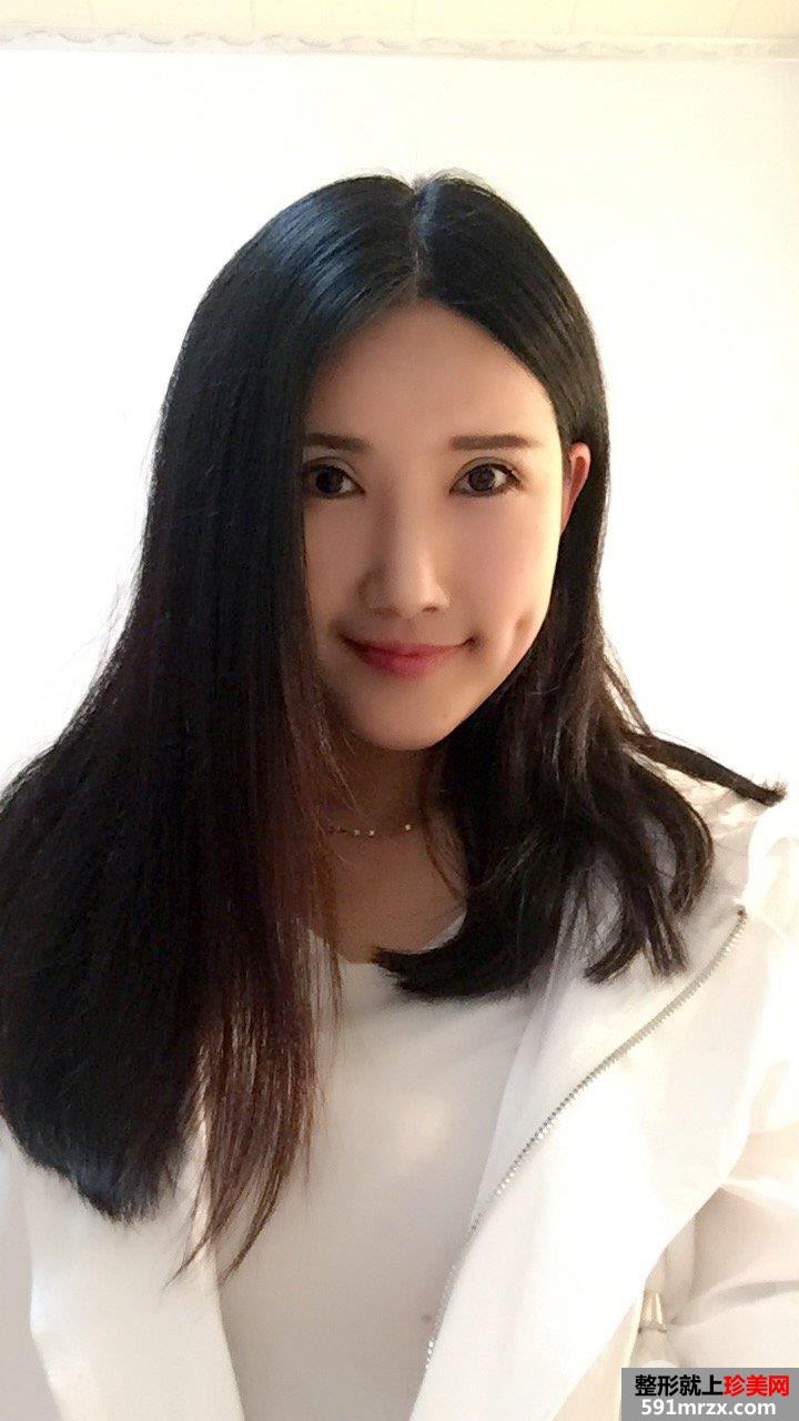 自体脂肪面部填充+双眼皮失败修复真实恢复记录