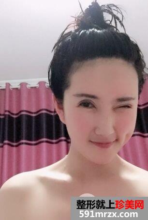 自体脂肪面部填充+双眼皮失败修复真实恢复记录