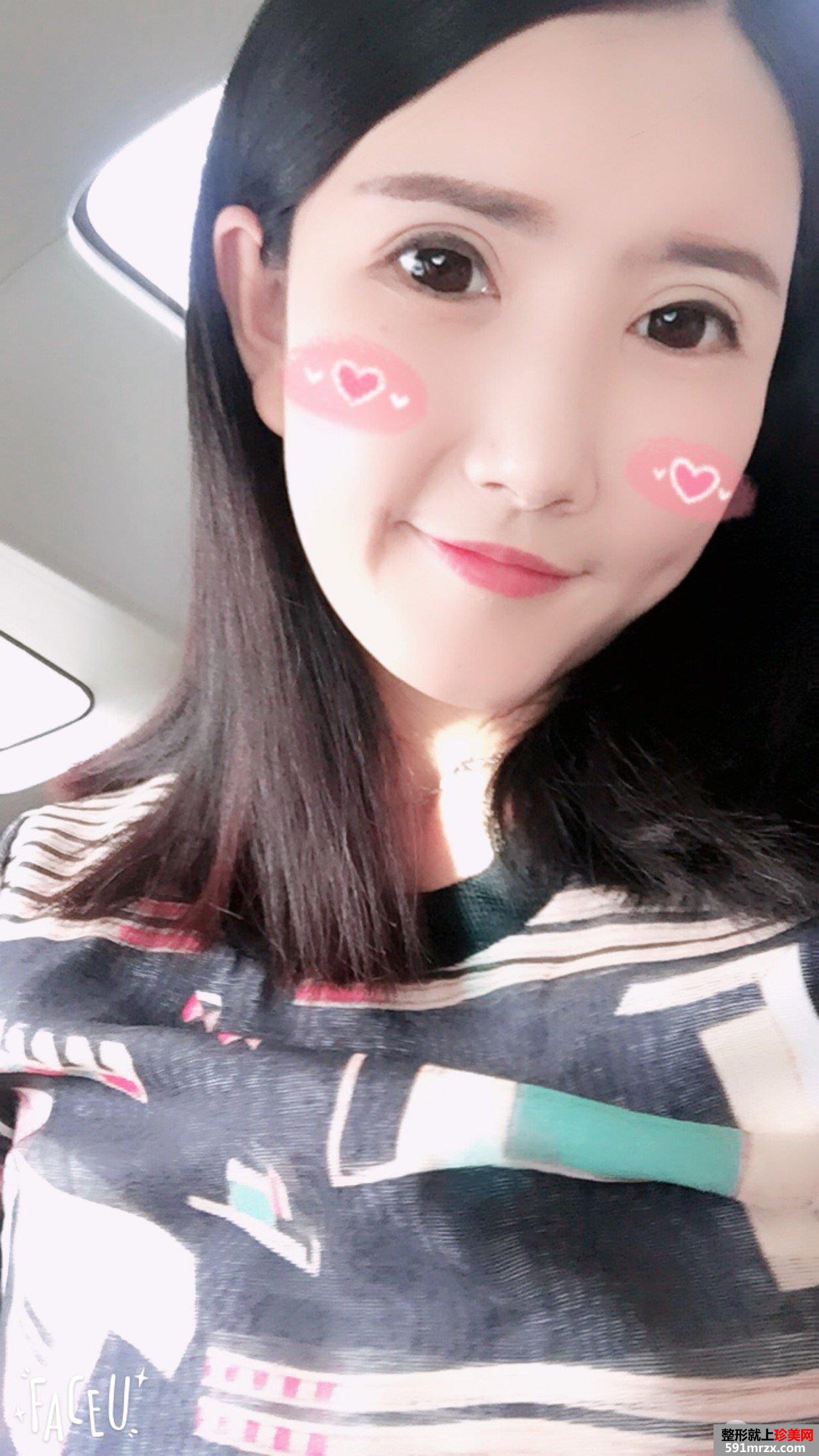 自体脂肪面部填充+双眼皮失败修复真实恢复记录