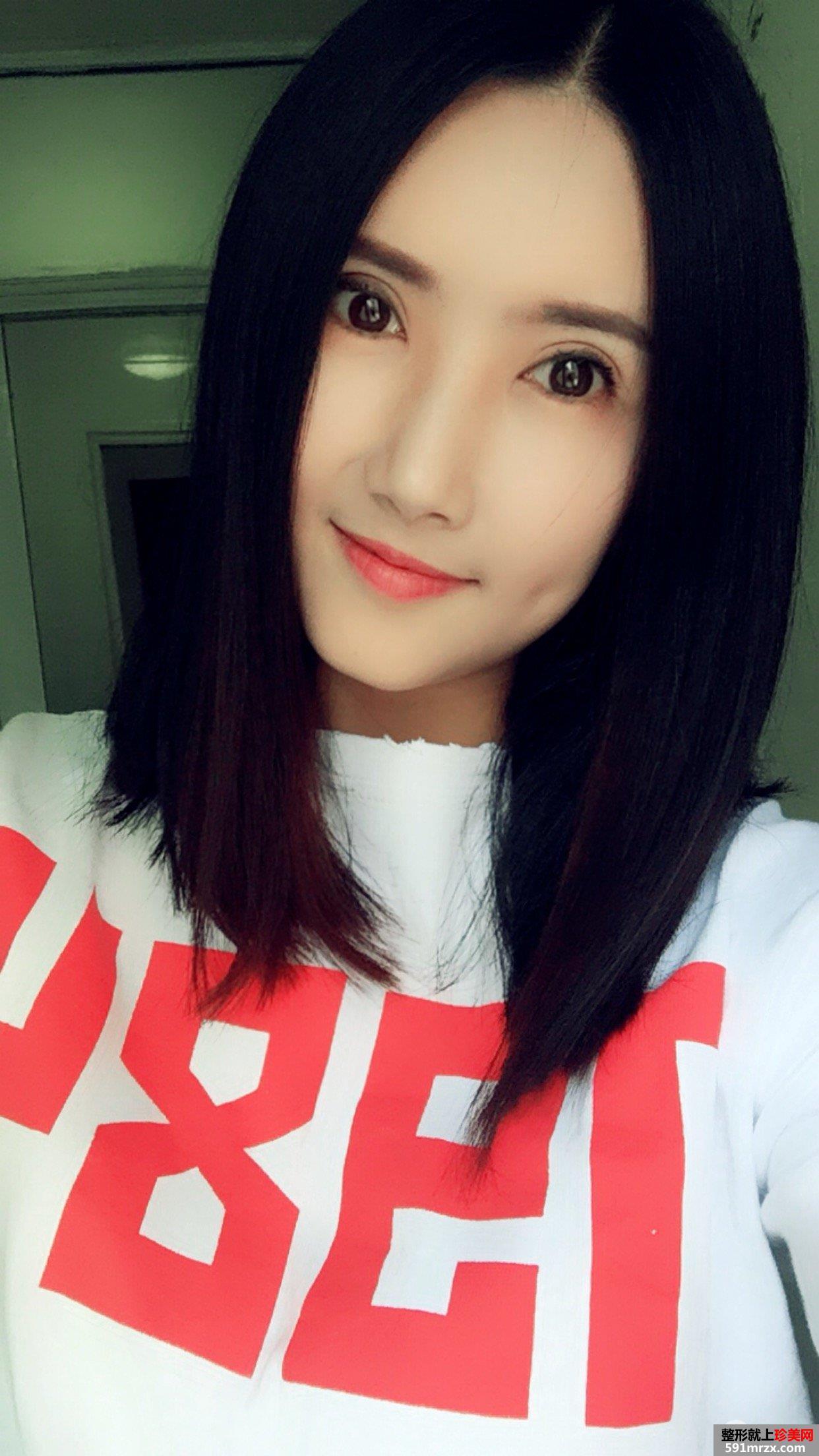 自体脂肪面部填充+双眼皮失败修复真实恢复记录