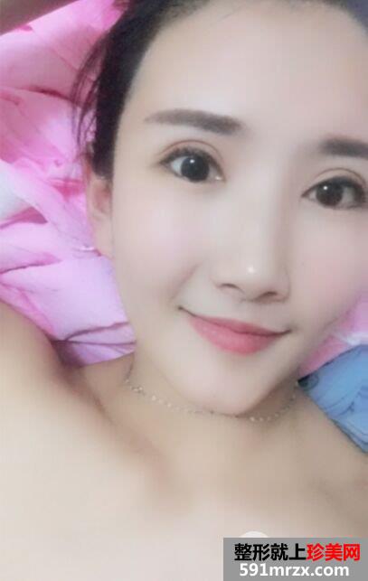 自体脂肪面部填充+双眼皮失败修复真实恢复记录