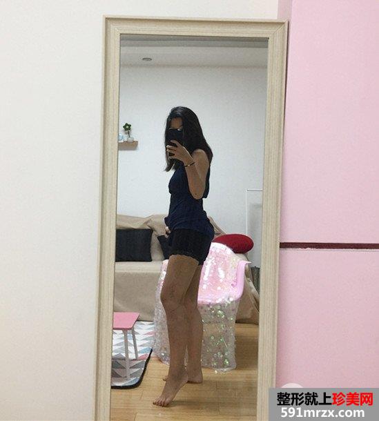 水动力吸脂瘦大腿亲身经历分享，快速拥有小细腿
