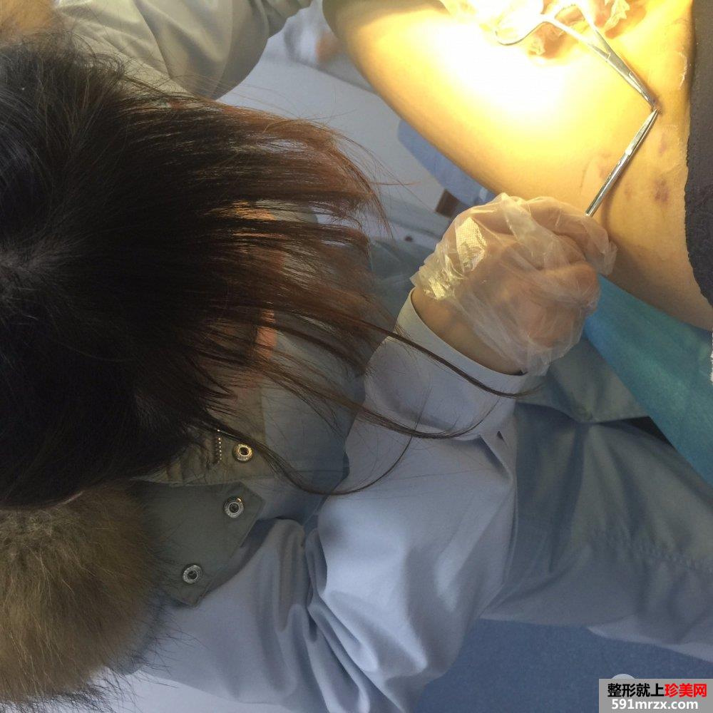 水动力吸脂瘦大腿亲身经历分享，快速拥有小细腿