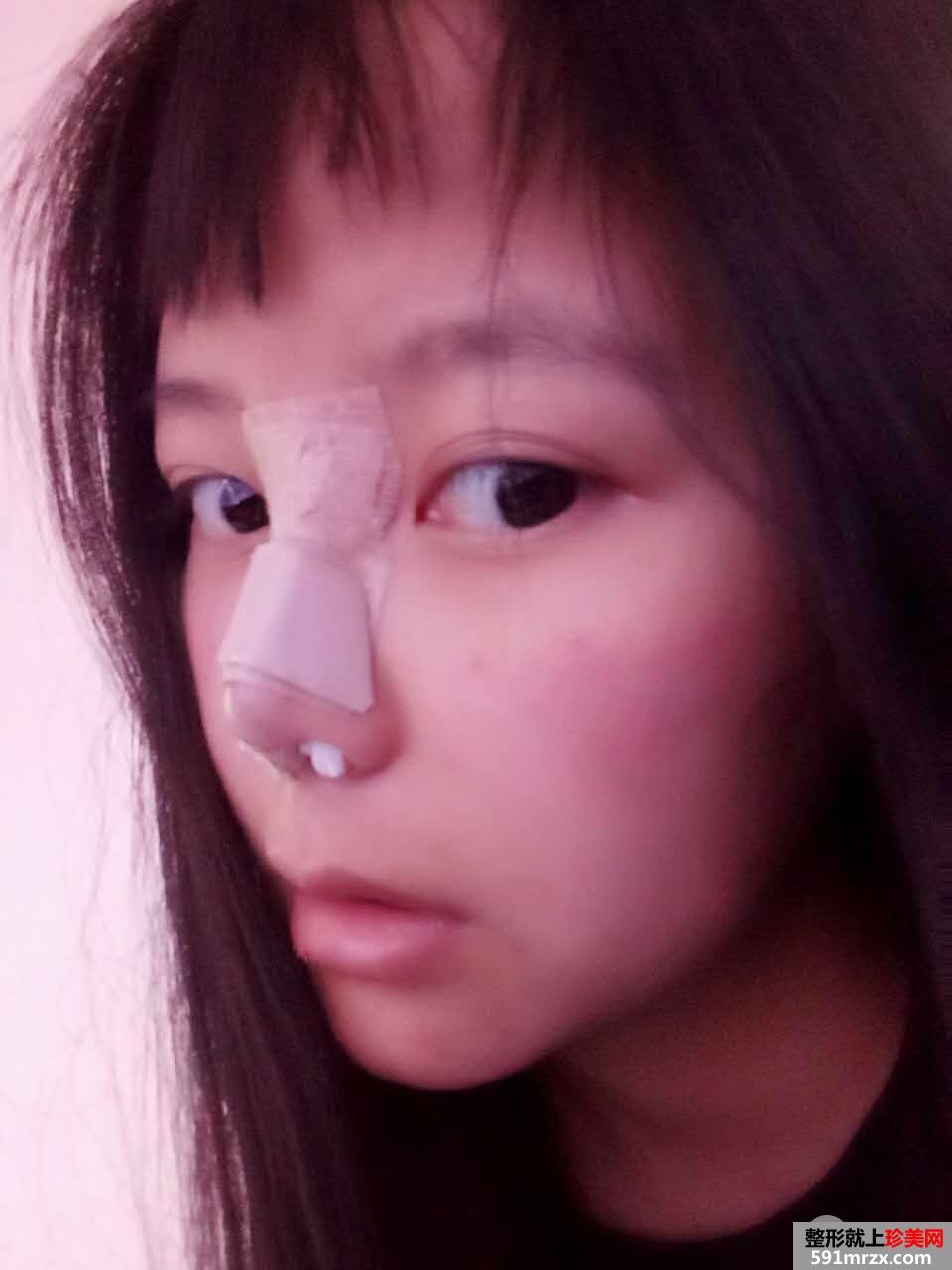 韩式生科假体隆鼻+耳软骨垫鼻尖前后对比分享，效果超乎想象