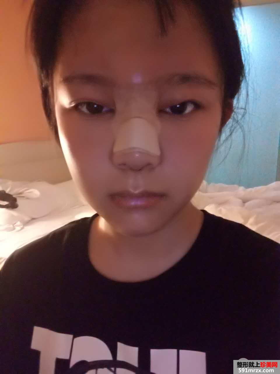 韩式生科假体隆鼻+耳软骨垫鼻尖前后对比分享，效果超乎想象