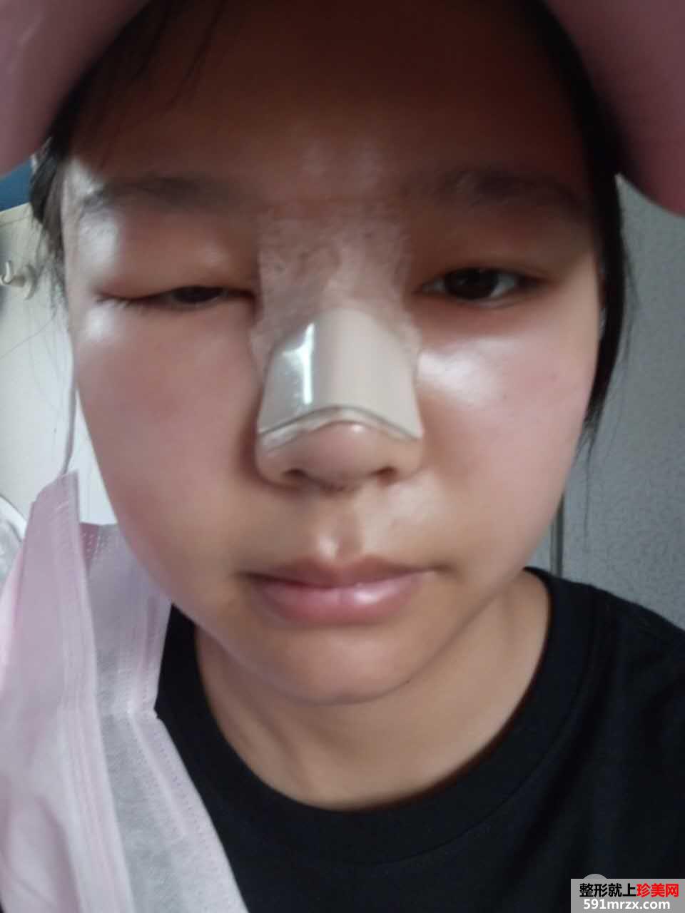 韩式生科假体隆鼻+耳软骨垫鼻尖前后对比分享，效果超乎想象